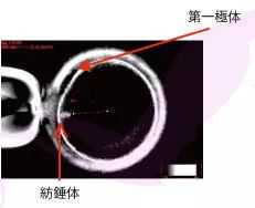 卵巢囊肿的病因是哪些呢